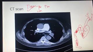 Lección 12 Tromboembolia Pulmonar en Tomografía Computarizada de Torax [upl. by Massingill]