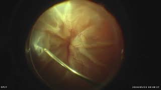 Surgery of funnel shaped retinal detachment hopeless or not [upl. by Lisha]