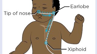 how to insert OG tube Orogastric tube in newborn baby cutebaby newbornbaby hospital nicubaby [upl. by Enneirda]