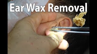 Ear Wax Removal 2019 [upl. by Lesoj]