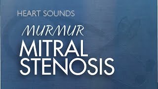 Mitral Stenosis Murmur  With Murmur Sounds Audio [upl. by Ehtylb447]