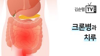 크론병과 치루의 관계 한의학박사 김순렬 [upl. by Iroc]