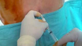 CSE combined spinal epidural anaesthesia needle to needle tecnique [upl. by Elamaj598]