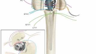 Equinoxe Platform Fracture Suture Animation [upl. by Leacim]