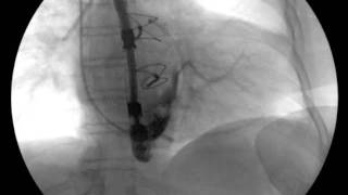 Coronary sinus catheter Fluoroscopy Correct placement [upl. by Auhesoj]