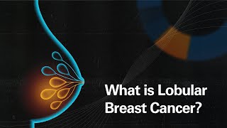 What is Lobular Breast Cancer [upl. by Derriey976]