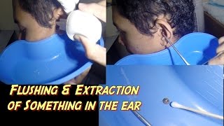 Flushing and Extraction of Something in the Ear Guess what is it [upl. by Goodwin782]