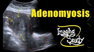 Adenomyosis  Ultrasound  Case 69 [upl. by Falconer270]