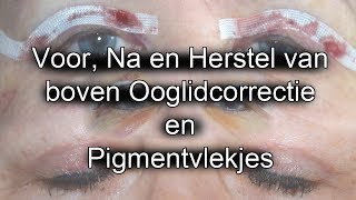 Review Boven Ooglidcorrectie en Ervaring Pigmentvlekjes verwijderen [upl. by Yona305]