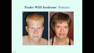 PraderWilli Syndrome  CRASH Medical Review Series [upl. by Benilda]