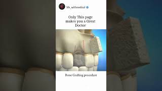 Bone Grafting Procedure medical doctor neet biology dentist [upl. by Llenahs]