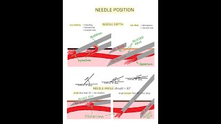 Venipuncture  How to Position a Needle [upl. by Annaillil549]