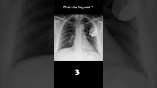 Implantable cardioverter defibrillator 164 Cardiac disease chest xray Quiz radiologychannel007 [upl. by Byram30]