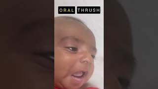 Treatment of Oral Thrush oralthrush treatment [upl. by Deering375]