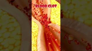 Heart Attack in an Animated Video  Shocking Symptoms and Signs [upl. by Coben]