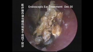 Cerumen mixed fungi similar to cholesteatoma 20231230 [upl. by Enirahtak]