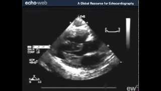 TheEchoWeb  Tetralogy of Fallot [upl. by Eleon]