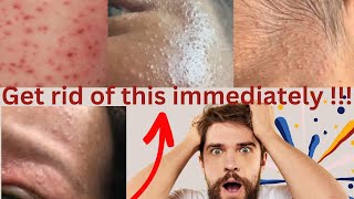 Gderm cream get rid of skin rashes pimples heat rash small Bumps amp more very effective 💯 [upl. by Ion757]