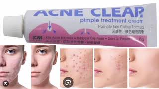 Acne Clear Pimple Treatment Cream [upl. by Neimad199]