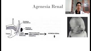 Agenesia Renal [upl. by Hadria214]