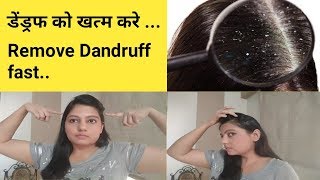 Get Rid of Dandruff in 1 Day Magical Home Remedy to remove Dandruff DIY Dandruff Treatment [upl. by Carolynn]