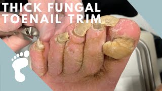 A Thick and Fungal Toenail [upl. by Derek239]