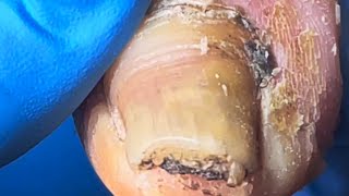 Onychomycosis Is Full Of Black Mud And It’S Too Dirty To Remove The Nails【Pedicure Master Lin Jun】 [upl. by Tierell484]