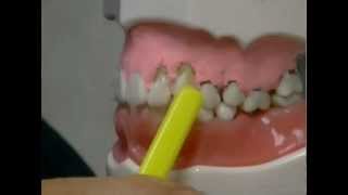 What Causes Gum Recession and How To Treat It [upl. by Irrac871]