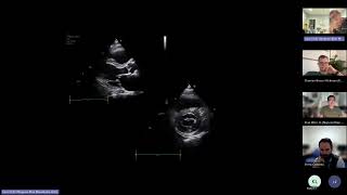 LV size function and haemodynamic assessment [upl. by Mailli]