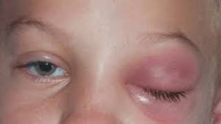 Blocked Tear Duct Nasolacrimal Duct Obstruction Symptoms and Causes  Diagnosis  Treatment [upl. by Ardet]