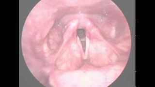 Vocal fold paralysis [upl. by Bobbie]