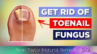 Top 3 Remedies for Toenail Fungus [upl. by Leirvag574]