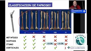 25 Revisión de Prótesis Total de Cadera Subsidencia del Tallo Femoral [upl. by Nagah]