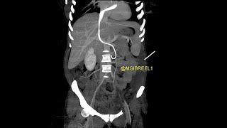 Intracardiac migration of ureteral doubleJ stent till the PV level [upl. by Erialb]