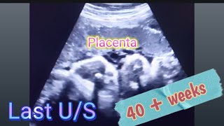 Baby BOY placenta position gender prediction  Anterior Placenta baby gender  how to reveal gender [upl. by Horten682]