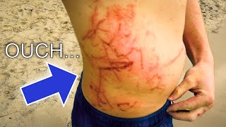 Stung by a BOX Jellyfish Philippines Port Barton Palawan [upl. by Hsetih]