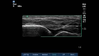 Ankle Ultrasound Ankle Joint Corticosteroid Injection [upl. by Beverie]