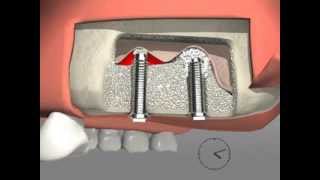 Smart Lift  Kit for Maxillary Sinus Lift with Crestal Approach [upl. by Adnahsat]