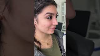 5D Nose Rhinoplasty  3 Months After at Anil Shah MD FACE [upl. by Kort799]