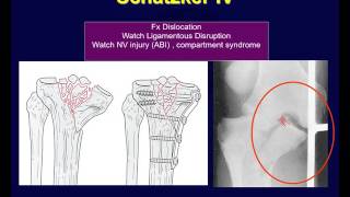 Tibial plateau fractures 2 [upl. by Ahsinom]