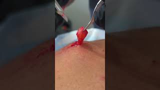 BACK CYST [upl. by Mahalia]