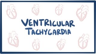 Ventricular tachycardia VT  causes symptoms diagnosis treatment amp pathology [upl. by Chaunce]