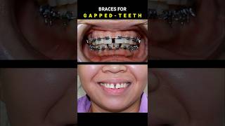 BRACES FOR GAPPED TEETH 32 MONTHS DURATION braces orthodontist dentist [upl. by Hsekin]