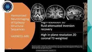 Neuroimagen en epilepsia  Dra Guadamuz [upl. by Hesta791]