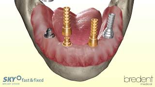 SKY fast amp fixed implant system  3D animation [upl. by Etoile856]