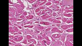 Histopathology Heart Amyloidosis [upl. by Farley233]