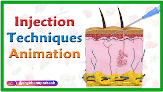 Injection Techniques Animation  Intradermal Intramuscular Subcutaneous and Z track [upl. by Allain]