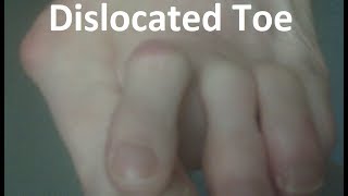 Dislocated Toe Pain Home Treatment Guide [upl. by Romanas]