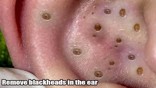 Remover big Blackhead in Ear [upl. by Nimref]