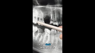 Do you need a bone graft if theres not enough bone [upl. by Ellesig]